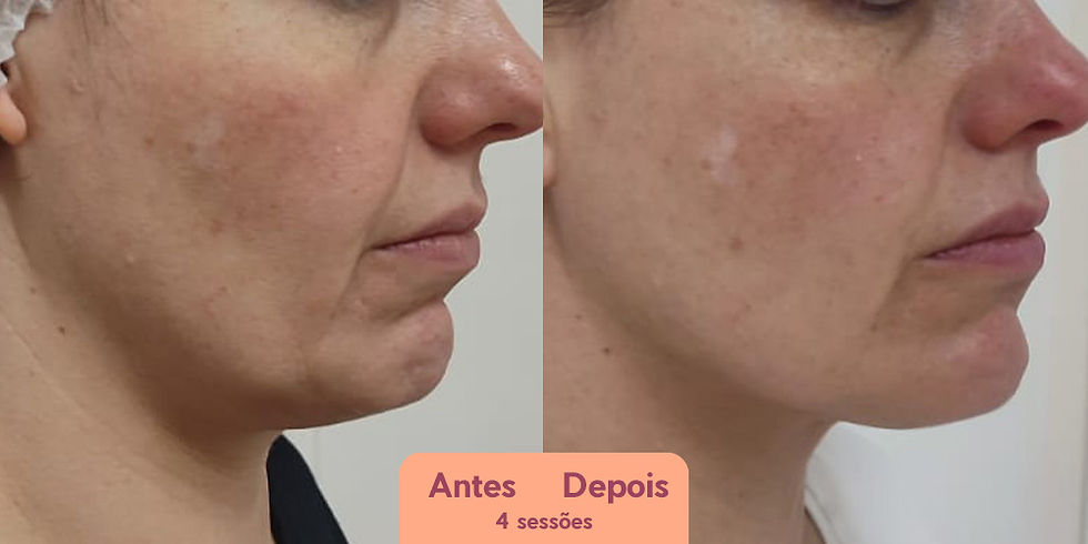 lineless-antes-depois-bioestimulador-colageno