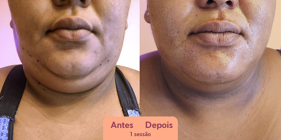 crioharmonização facial
