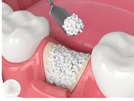 Kemik Grefti Nedir? İmplant Öncesi Kemik Tozu Uygulaması (Eskişehir 2026)