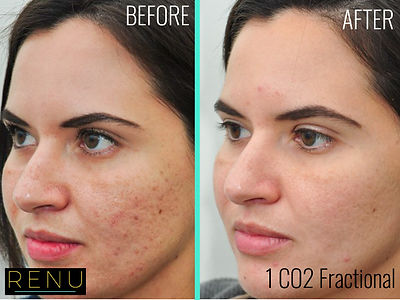 acne-scar-removal-before-after-co2-fractional-laser-treatment.jpg