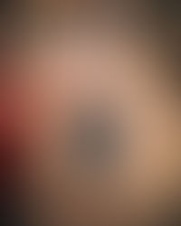 GLI ANEDDOTI DI ALDO                      "LA STAMPELLA E LA SCARPA IN FELTRO"