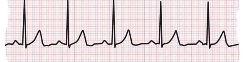 ECG-normal.jpg