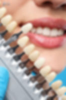 Porcelain Veneers