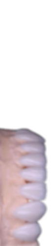 Veneers_edited.png