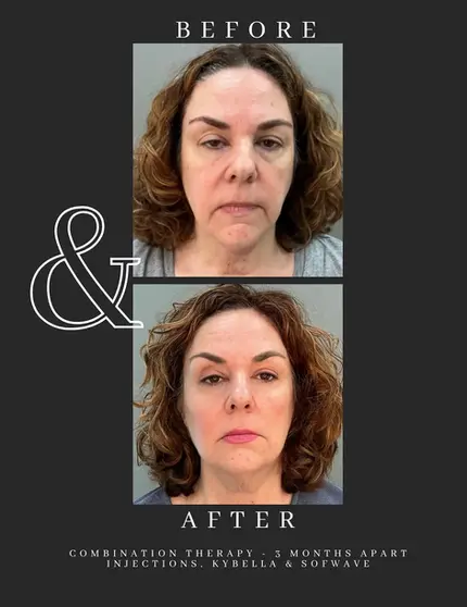 combo therapy kybella and sofwave