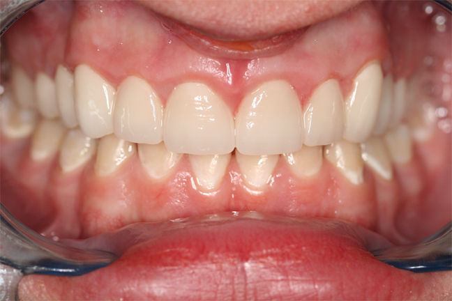 Patient 9 After