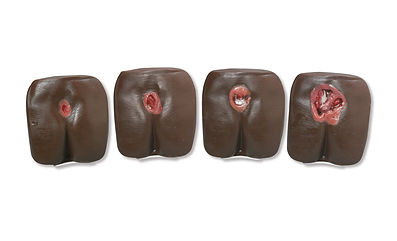 wa pressure ulcer staging.jpg