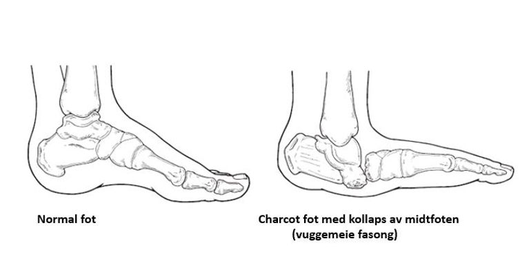 wounds charcot fot skjelett.JPG