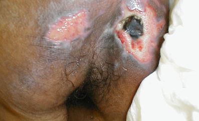 wa pressure ulcers 2.jpg