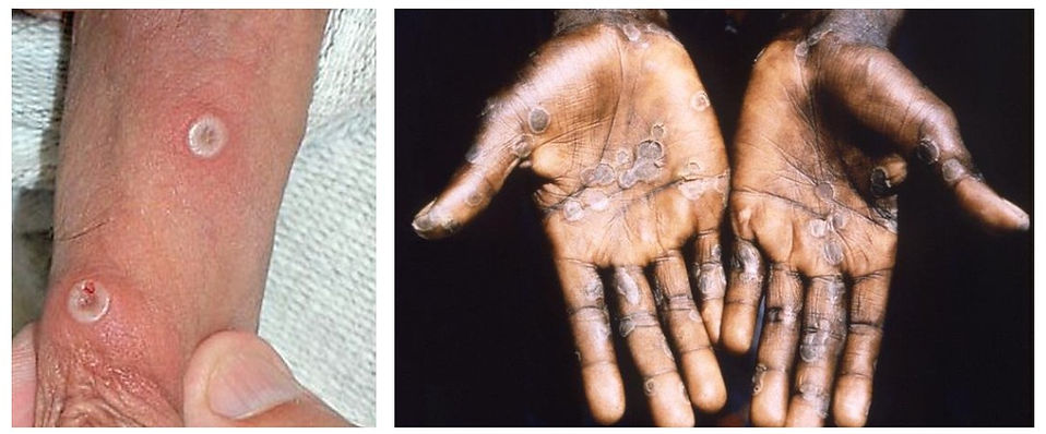 mpox 2.jpg