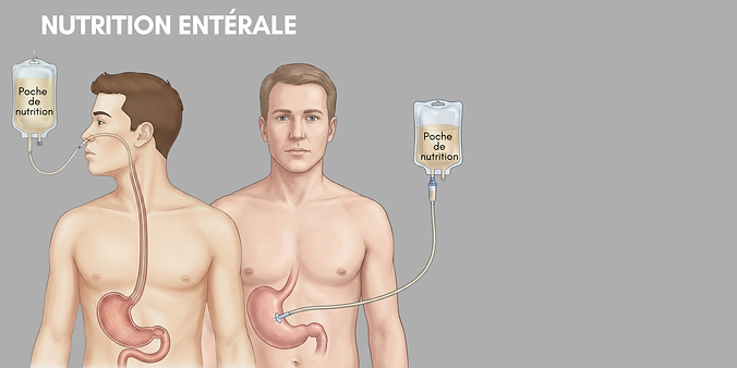 nutri entérale.png
