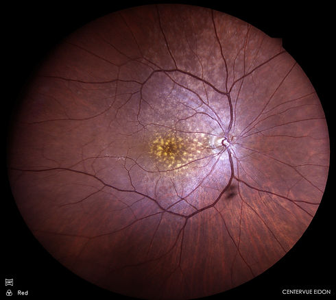 건성 황반변성.jpg