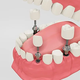 DentlaImplant_1.png