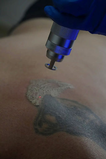Tatto Removal_edited_edited.jpg