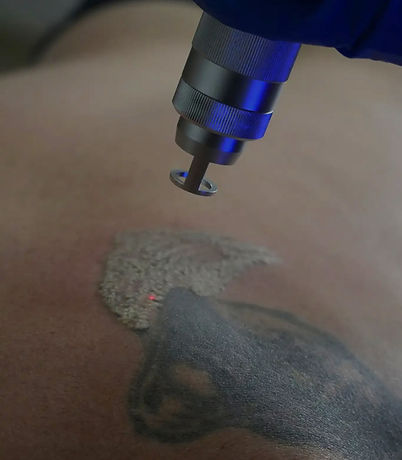 Tatto Removal_edited_edited.jpg