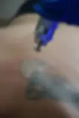 tattoo removal.webp