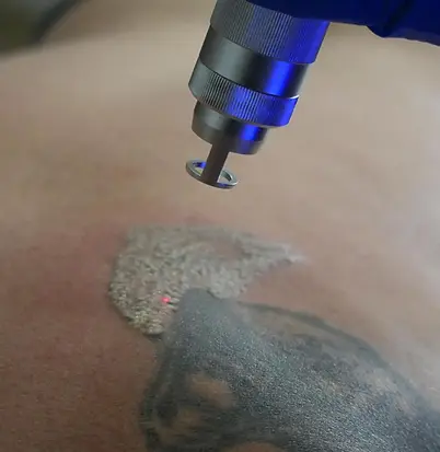 tattoo removal.webp
