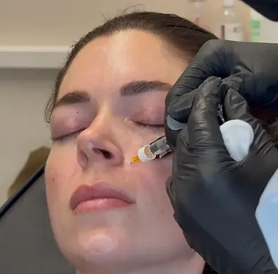 Dermal Fillers at LBL Aesthetics and Laser in Essex (6).webp
