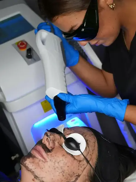 Carbon Laser Facial.webp