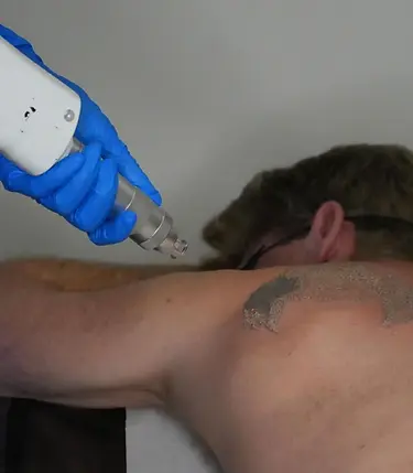 Tatto Removal (2).webp