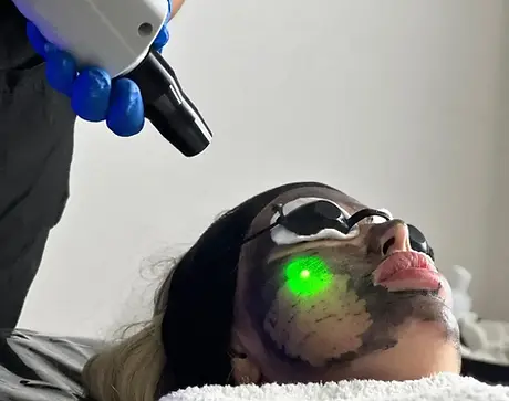 Carbon Facial Laser (4).webp