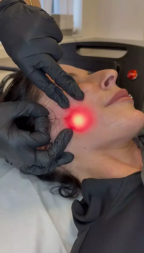 Endolift Treatment.webp