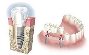 Clinica dental en Madrid Dr. Estévez, dentista en madrid, implante dental