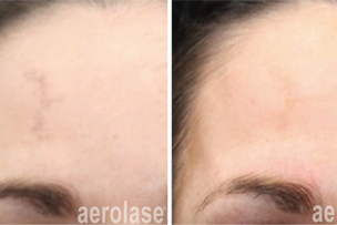 Neo spider veins on face treatment