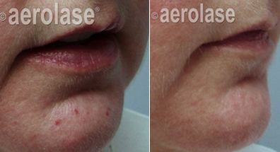 image of aerolase before and after skin of women