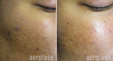 image of aerolase before and after skin of women