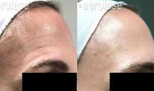 Fine Lines & Wrinkles Treatment