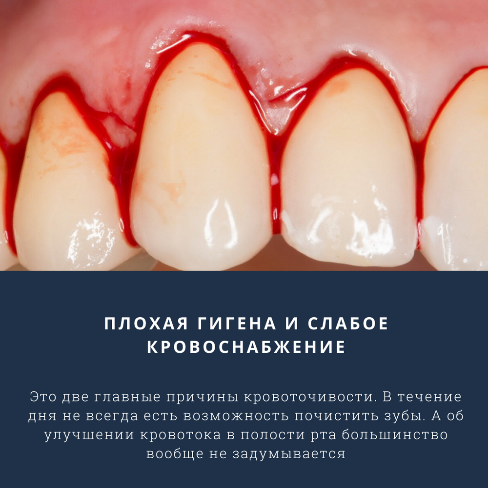 Средство против кровоточивости десен. Массирование десен и их укрепление.