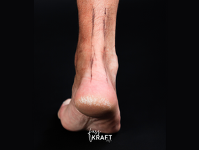 Patient mit einer Achillessehnen-Tendinopathie