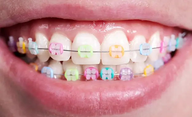 Clear Ceramic Braces