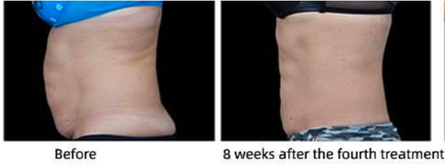 HIFEM電磁パルス痩身 | ALL in ONE