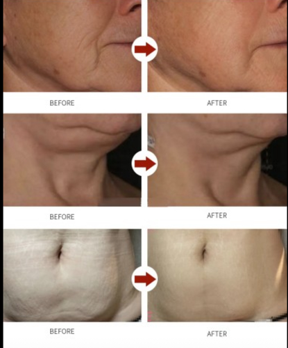 ウルトラリフト | ALL in ONE