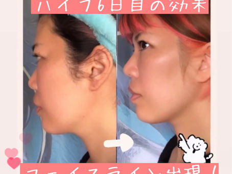 ハイフ6日後はもっと凄い!