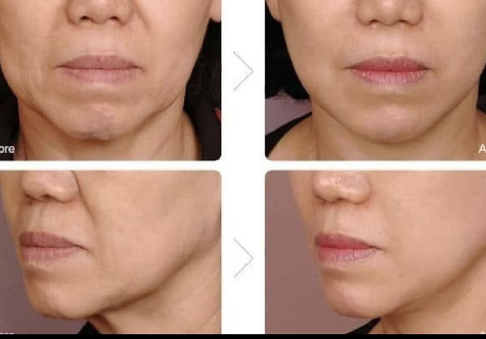 顔４Dハイフの効果Before After2