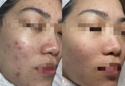 プラズマフェイシャルマシン プラズマフェイシャル 2ハンドル | ALL in ONE