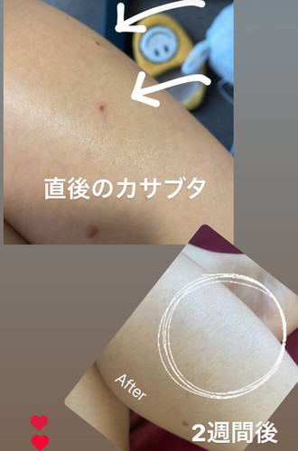 シミ取り フラッシュプラズマ ワンハンドル【送料込み/税別】 | ALL in ONE