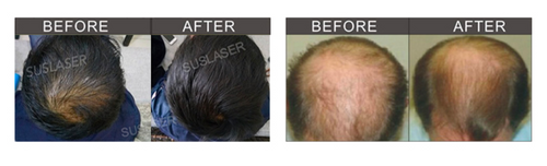 育毛 レーザー照射 血行促進マシン | 大阪 ALL in ONE 