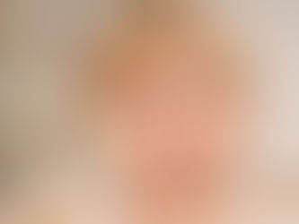 Estrabismo em criança desaparece sozinho?