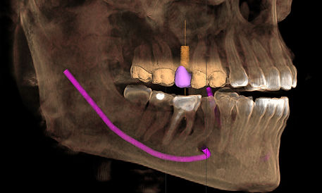 Implant dentist Port Macquarie