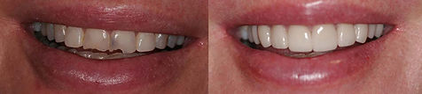 veneer-before-after.jpg