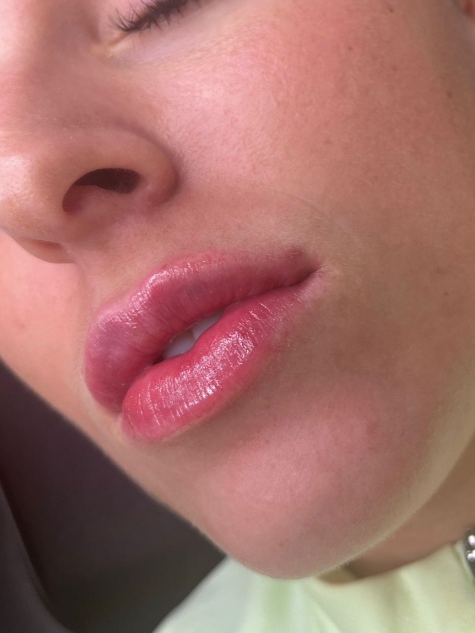 lip-filler-newcastle_edited