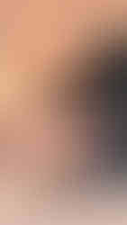 Medilift Ablatif Diode Lazer ile Gıdı Liposuction, Eritme ve Sıkılaştırma