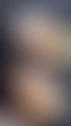 Medilift Ablatif Diode Lazer ile Gıdı Liposuction, Eritme ve Sıkılaştırma