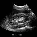 Kindey ultrasound.jpg