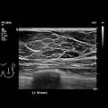 breast ultrasound.jpg