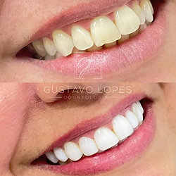 Facetas em Resina + Clareamento